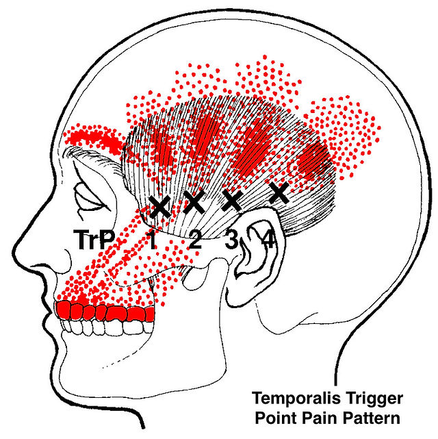 TrP