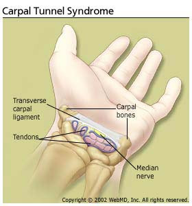 carpal tunnel syndrome
