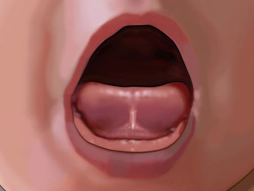 Tongue, Lip, and Buccal Ties