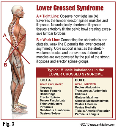 Lower Crossed Syndrome