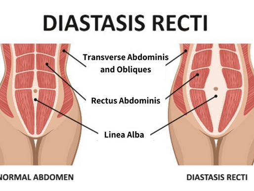 Diastasi Recti Abdominis (DRA)