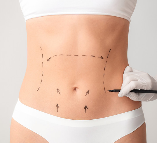 Mini Abdominoplastia