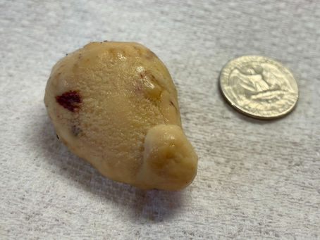 Salpingitis and lash eggs