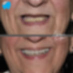 Removable Denture At elite dental clinics Dr.Mohamed Mounir