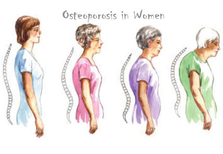 Building Strong Foundations: Exercise to Combat Osteoporosis
