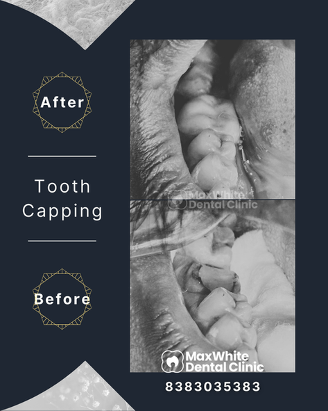 Tooth cap procedure for restoring tooth structure in East Delhi