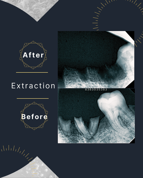 Dentist performing painless tooth removal in Dilshad Garden