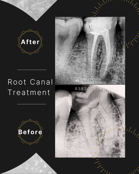 Modern root canal procedure to treat infected tooth at MaxWhite Dental Clinic East Delhi