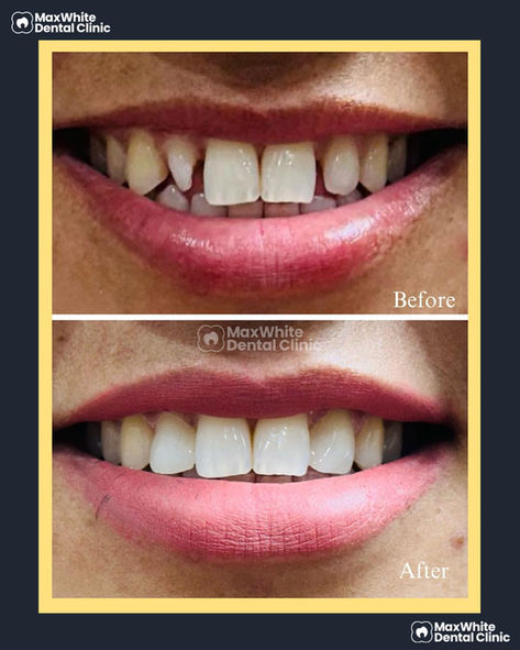 Teeth gap corrected with composite bonding