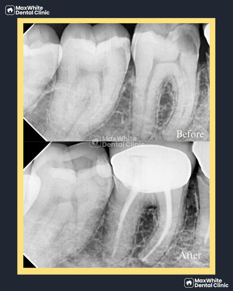 Painless root canal treatment procedure at MaxWhite Dental Clinic in Dilshad Garden East Delhi
