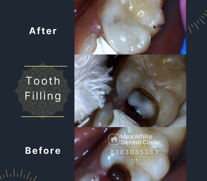 Dental cavity filling procedure at MaxWhite Dental Clinic East Delhi