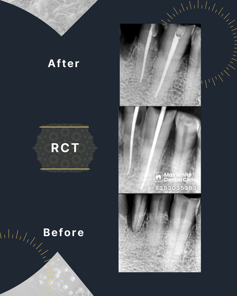 Root canal treatment for tooth pain and infection at MaxWhite Dental Clinic Dilshad Garden