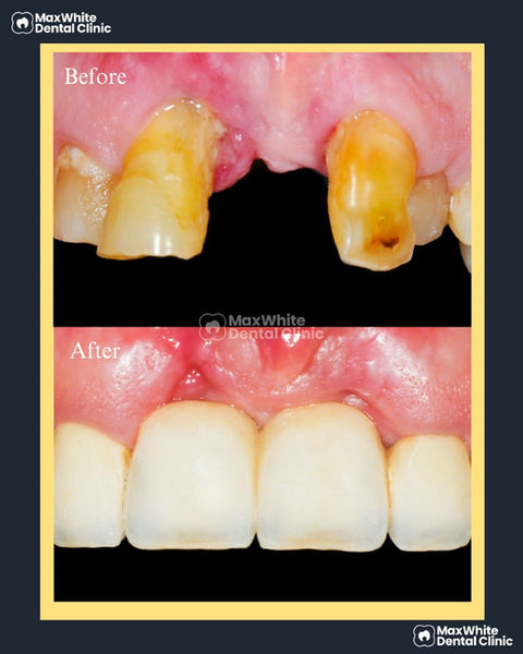 Before & After crown and bridge treatment