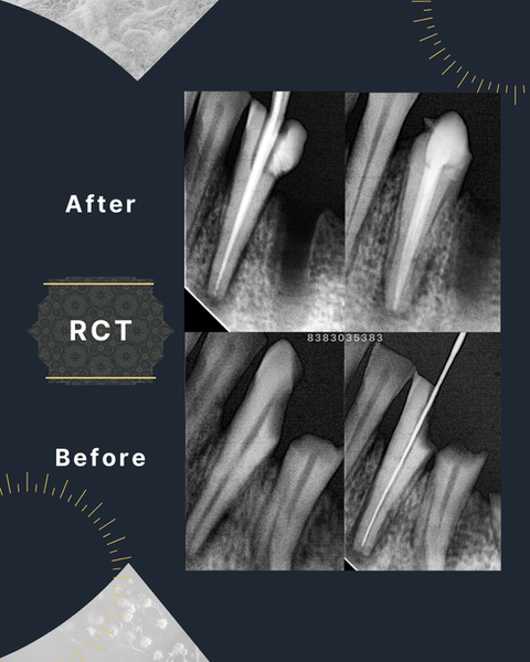 Painless root canal treatment procedure at MaxWhite Dental Clinic in Dilshad Garden East Delhi