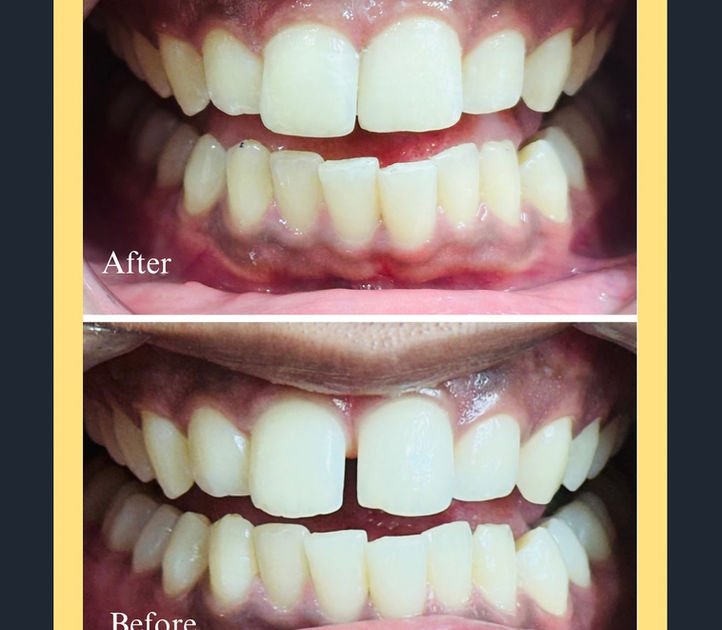 Teeth Gap closed with Veneers
