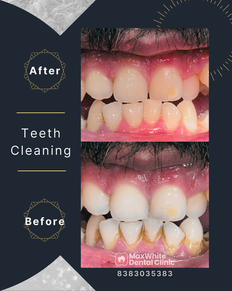 Professional teeth scaling and cleaning at MaxWhite Dental Clinic East Delhi