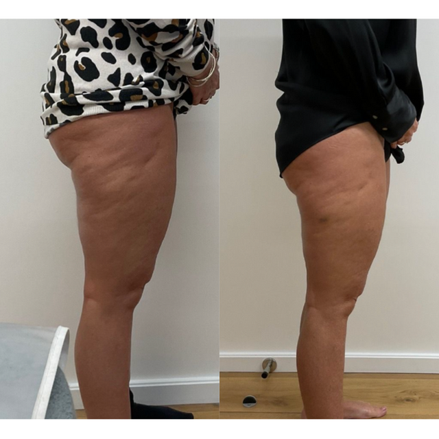 lemon bottle fat dissolving thighs Carnitina: Come assumerla e perché fa dimagrire?