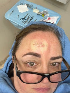 After MOHS surgery- Three deep on the forehead- two deep on the cheek.