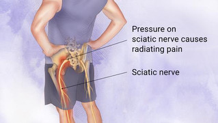 New Study on Sciatica