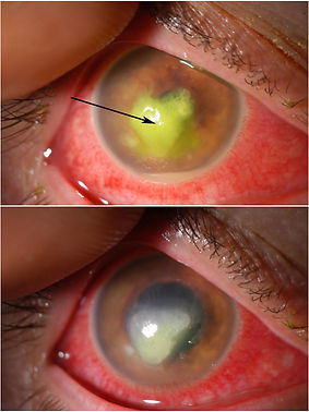 ulcera corneal