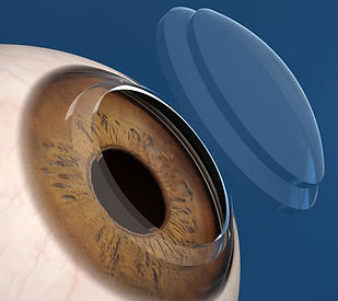 trasplante de cornea