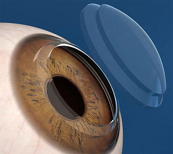 trasplante de cornea
