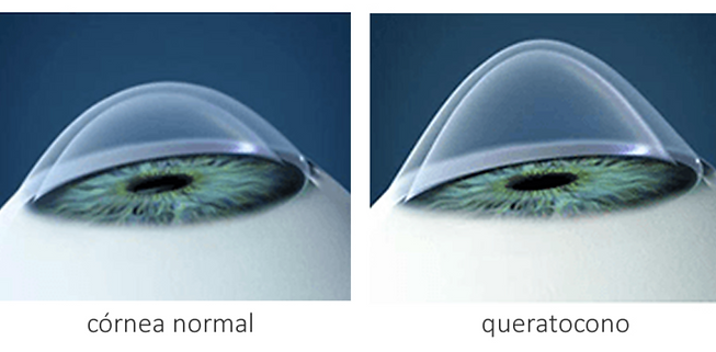 queratocono ojo