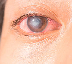 úlcera-corneal