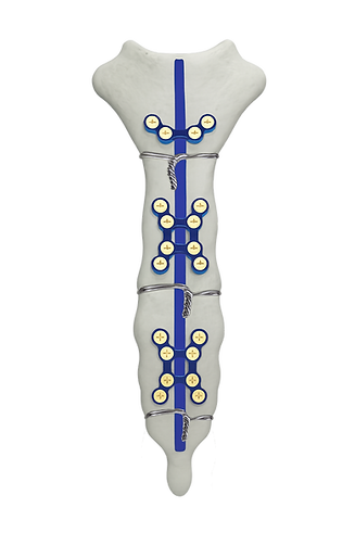 Sternum with ThoraGraft supporting both fixations methods