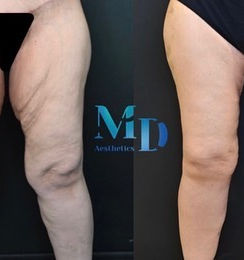 Lifting des cuisses en Turquie avec Murat Diyarbakirlioglu et Estetica Istanbul