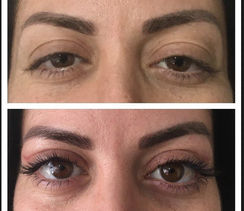 Blépharoplastie en Turquie avec Kemal Aytuglu et Estetica Istanbul