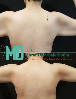 Lifting des bras en Turquie avec Murat Diyarbakirlioglu et Estetica Istanbul