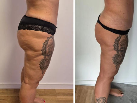 Cellulite verstehen und sanft behandelnEin grosser Schritt zu glatterer Haut