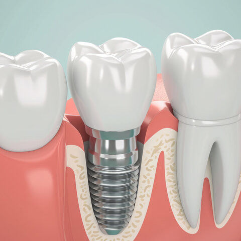 Dental Implants