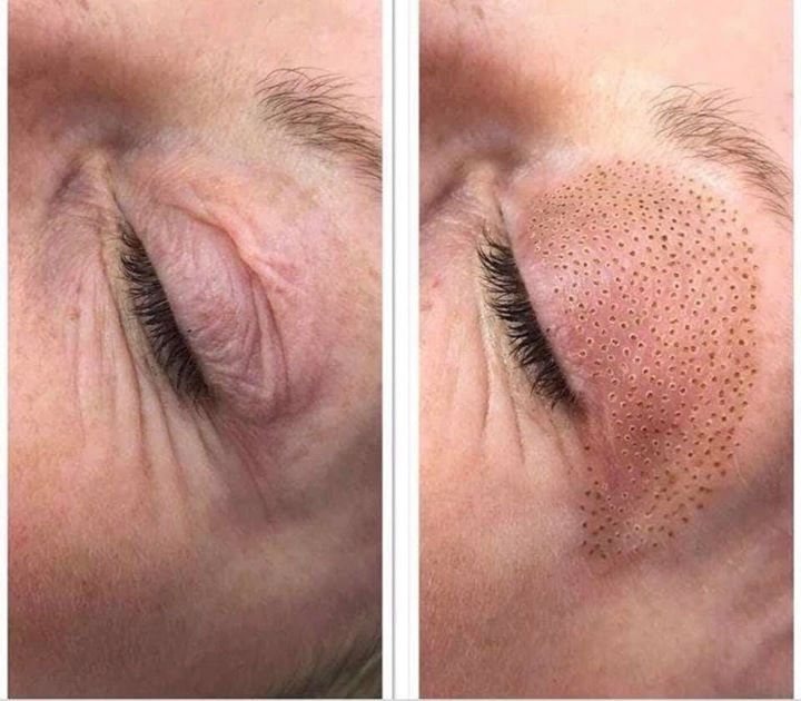 Sagging eyelid_ Bye 👋