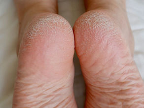 Cracked Skin? The Homeopathic Help You’ve Been Looking For