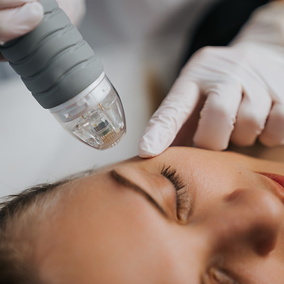 Model getting RF microneedling treatment done by a professional