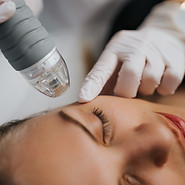 Model getting RF microneedling treatment done by a professional