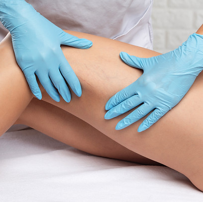health practitioner’s hands indicating veins on models legs