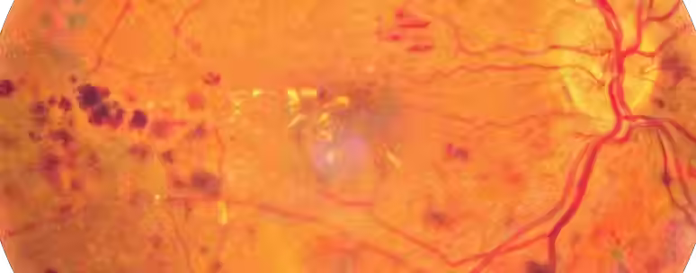 Retinopatia Diabética