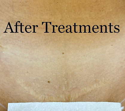 Diode Laser Hair Removal