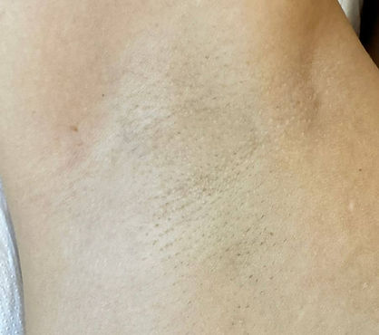 Diode Laser Hair Removal