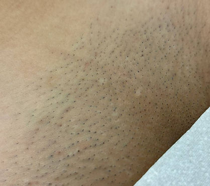 Diode Laser Hair Removal