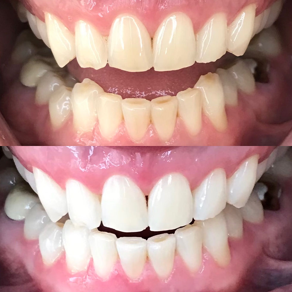 Top and bottom comparison close ups of client's teeth showing the shades of whitening improvements 9