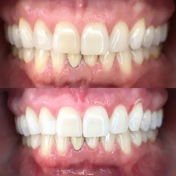 Pocatello Teeth Whitening Smile Hy Teeth Whitening