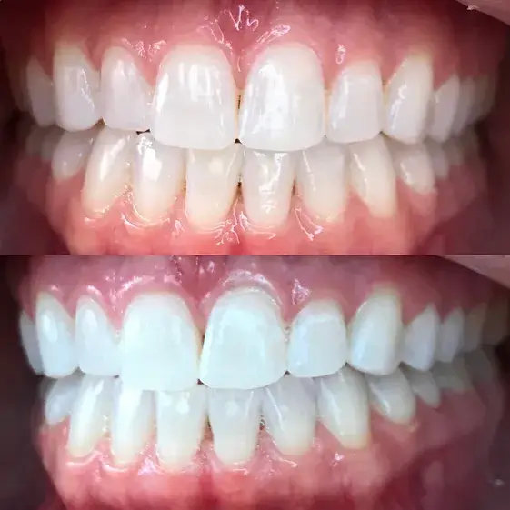 Pocatello Teeth Whitening Smile Hy Teeth Whitening