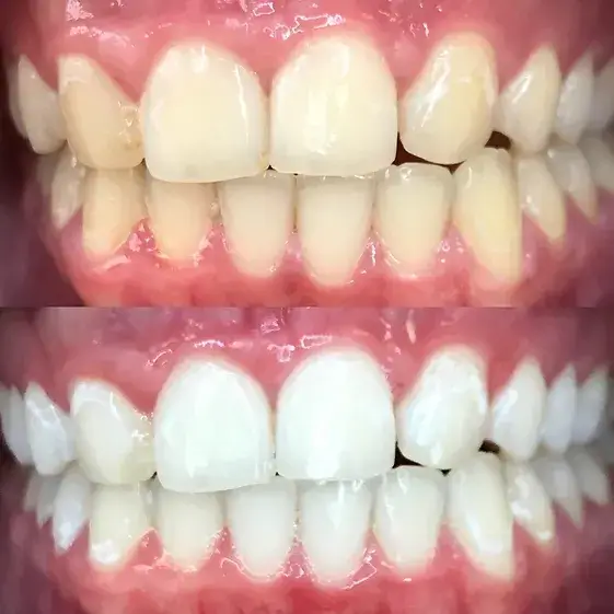 Pocatello Teeth Whitening Smile Hy Teeth Whitening