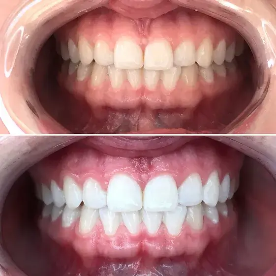 Pocatello Teeth Whitening Smile Hy Teeth Whitening