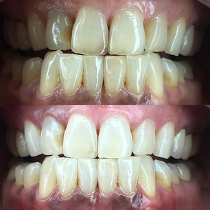 Top and bottom comparison of close ups of client's teeth showing the shade improvements from using Smile Hy teeth whitening-7