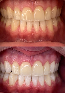 Top and bottom comparison of close ups of client's teeth showing the shade improvements from using Smile Hy teeth whitening-4